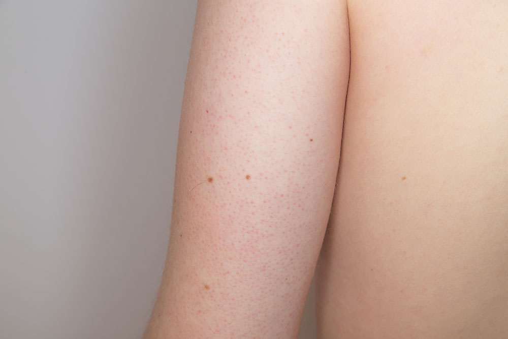 An overview of keratosis pilaris