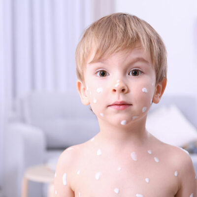 Chickenpox &#8211; Symptoms, complications, and prevention