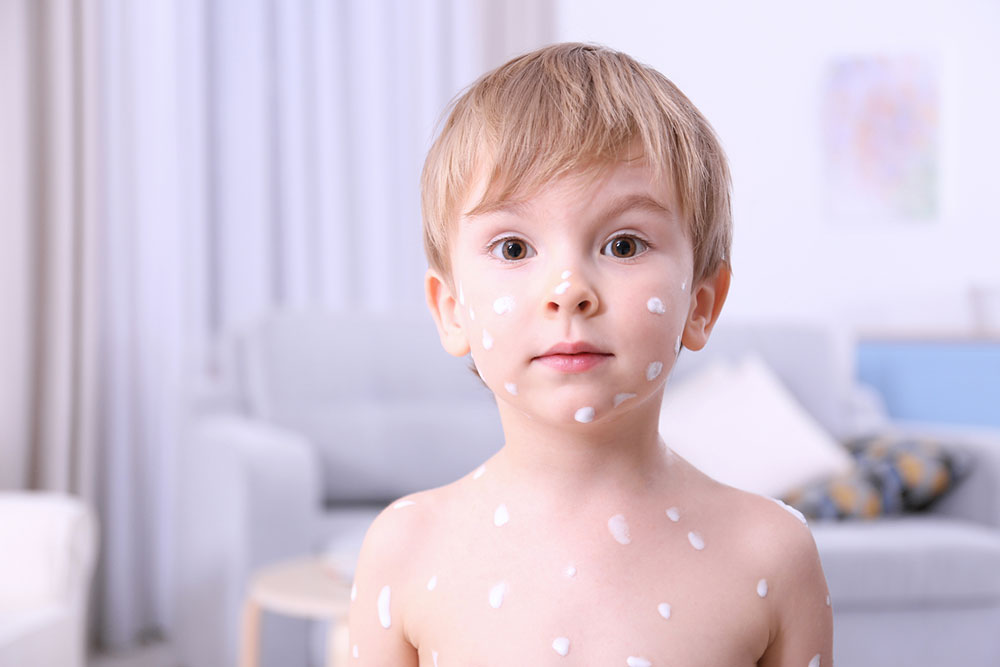 Chickenpox &#8211; Symptoms, complications, and prevention