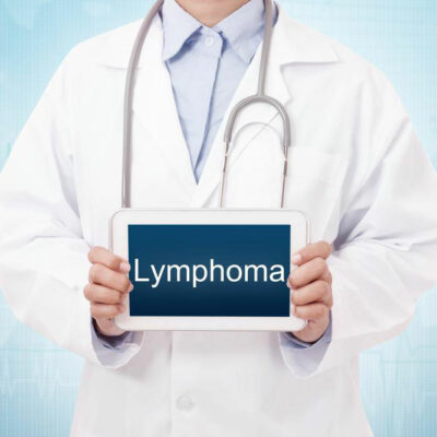 4 methods of treatment for non-Hodgkin&#8217;s lymphoma