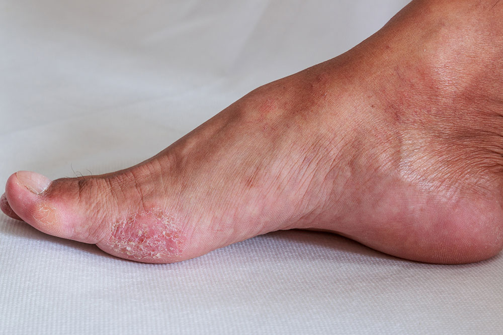 5 common types of fungal infections