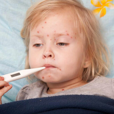 5 things to know about measles