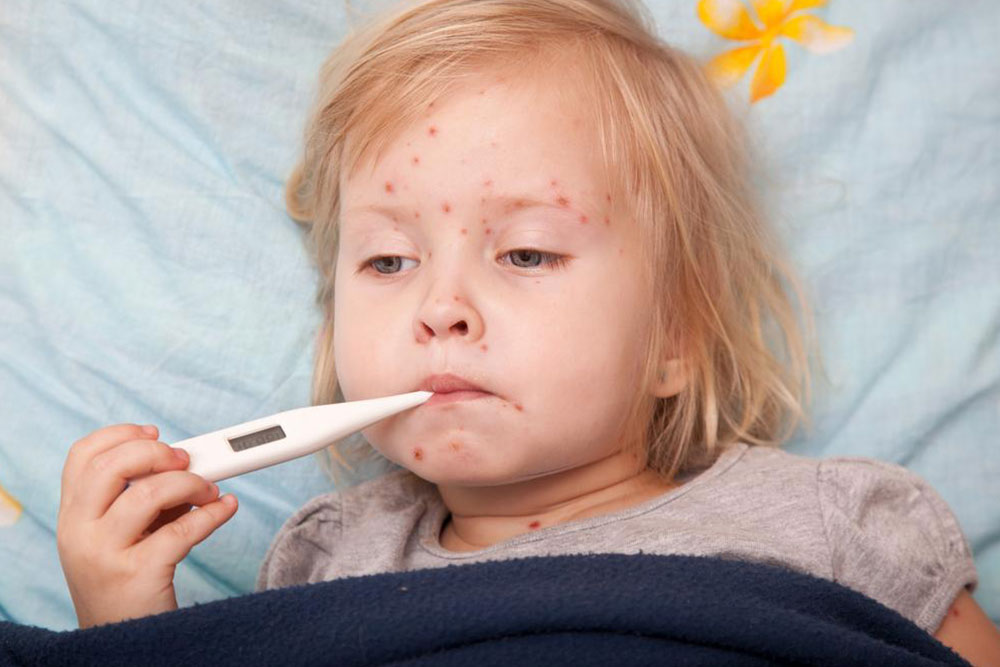 5 things to know about measles